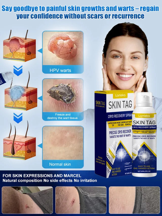 LANISKA Wart Care Topical Spray